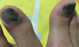 Black toenails