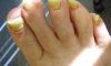 Yellow toenails