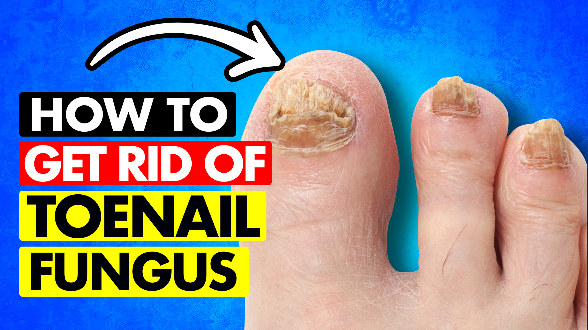 getting-rid-of-toenail-fungus