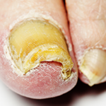 Toenail Fungus Infection