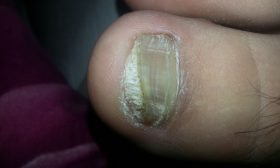 Nail Fungus Prevention