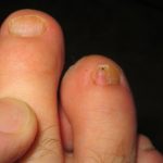 Nail Fungus