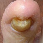 Toenail Fungus