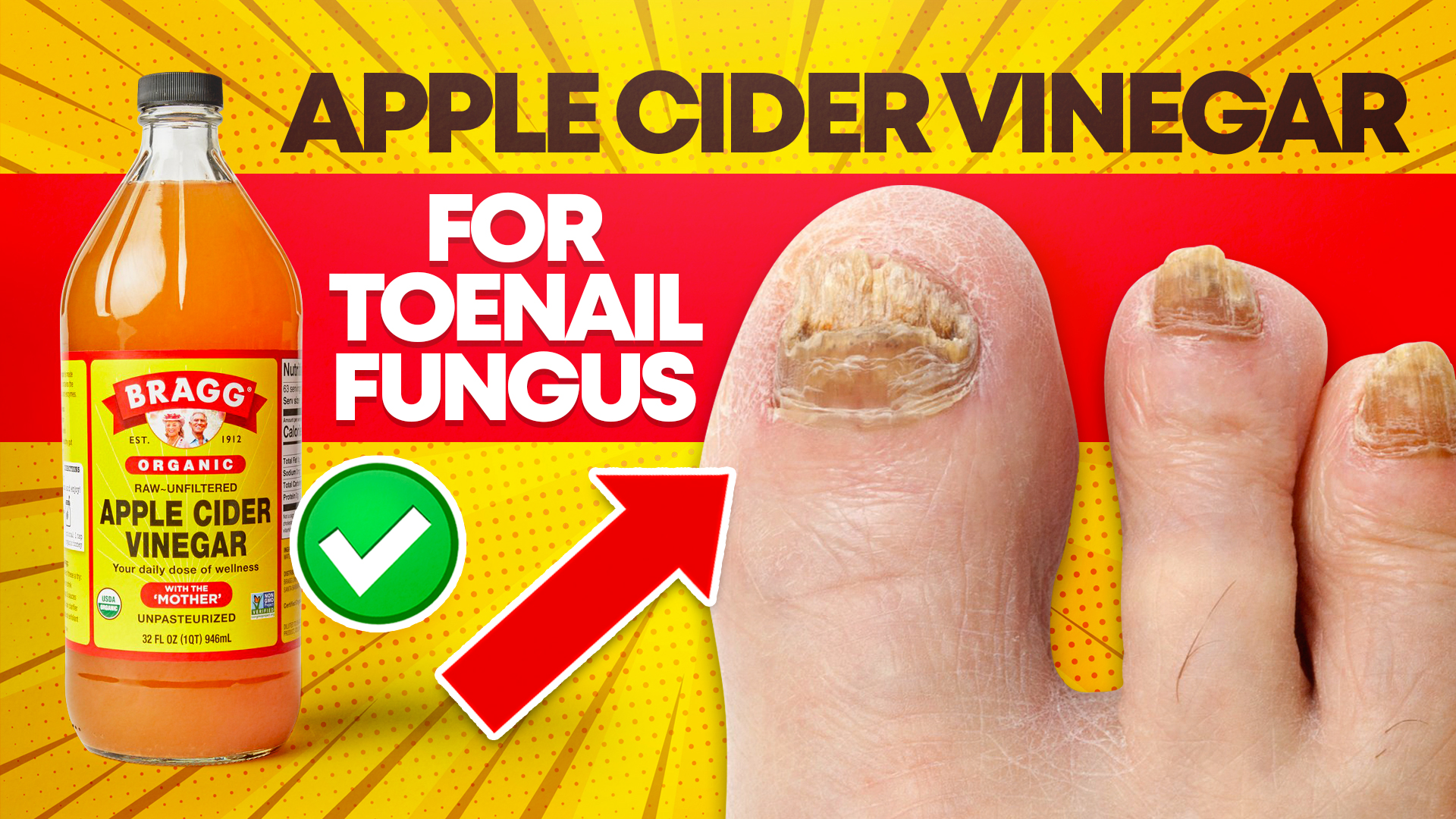 How Effective is Apple Cider Vinegar for Toenail Fungus? Cure Toenail